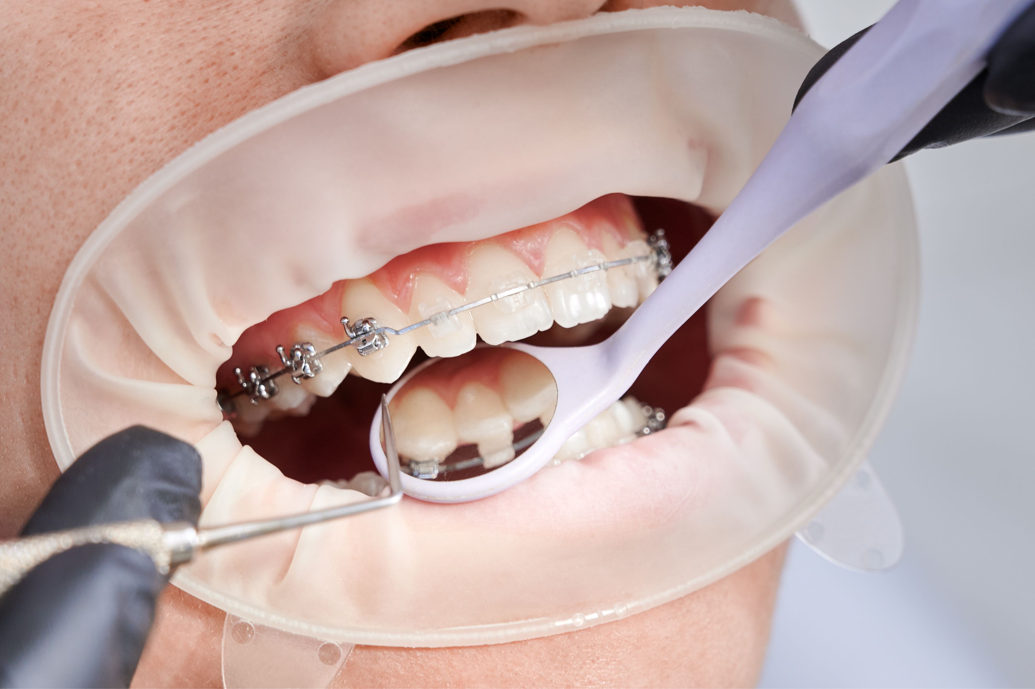 ORTHODONTIC (Braces)